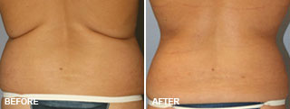 Liposuction BEFORE & AFTERS 