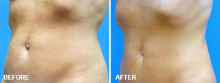 Liposuction BEFORE & AFTERS 