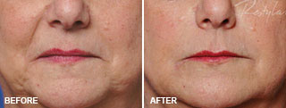 Restylane® BEFORE & AFTERS 