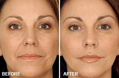 Restylane® BEFORE & AFTERS 