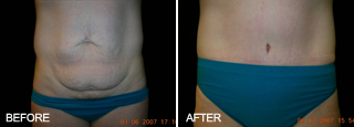 Abdominoplastia antes y despues