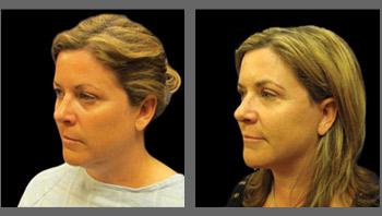 Uplift® BEFORE & AFTERS
