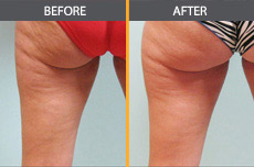 Cellulite Reduction in Chicago