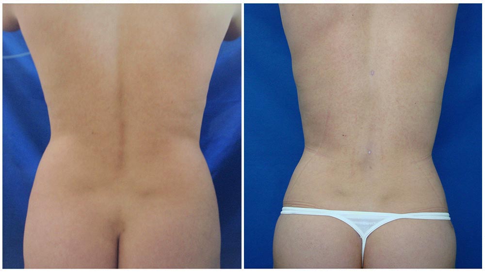 Photo Gallery - Chicago Liposuction by Lift Body Center