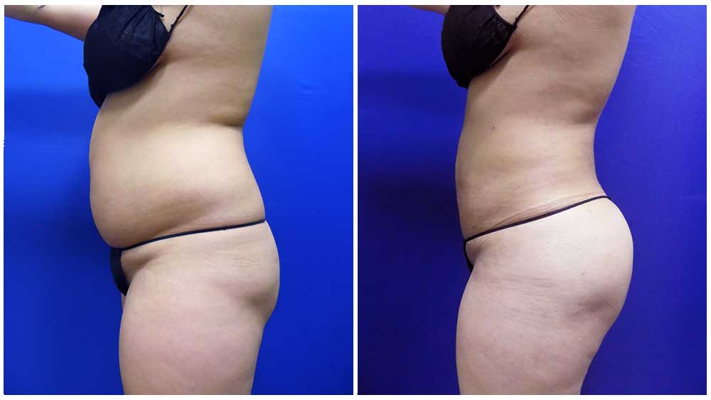 Waterlipo™ for Fat Removal