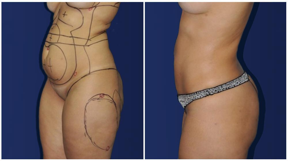 Smartlipo Before and After