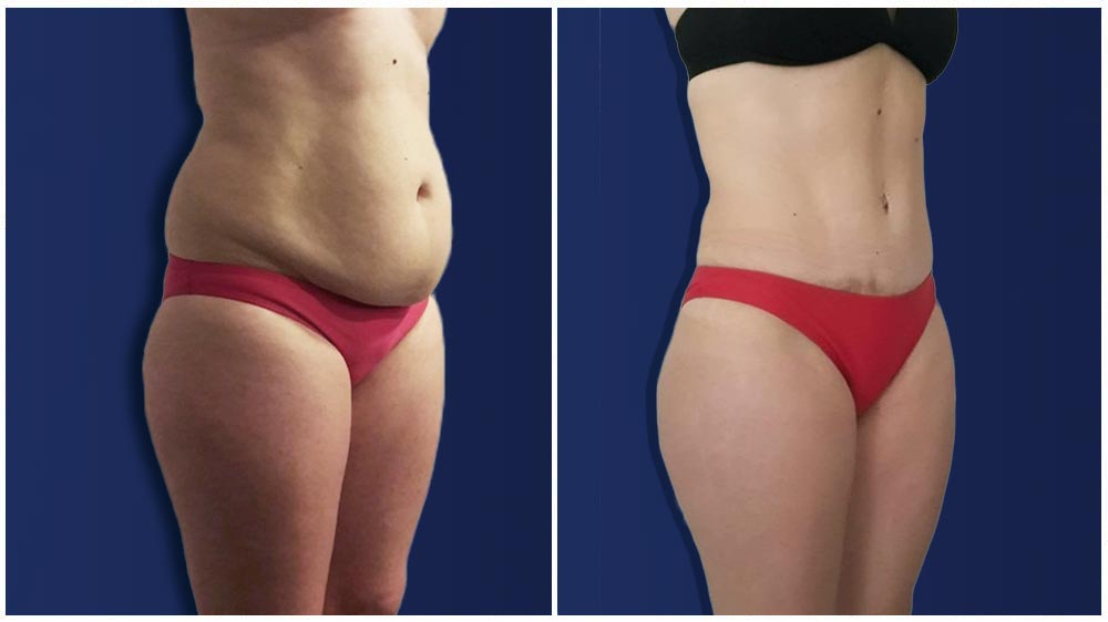 Smartlipo Before and After