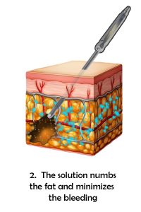 Tumescent Liposuction process - numb the area