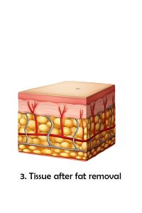 Tissue after fat removal
