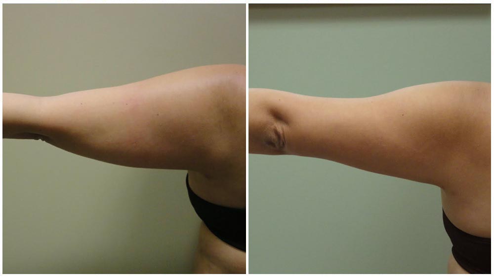 Arm Liposuction Chicago - Liposuction Lift Body Center