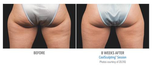 Coolsculpting in Chicago