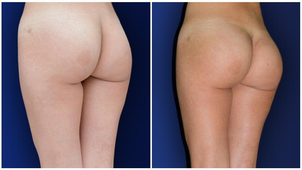 Buttock Liposuction Chicago - Chicago Liposuction by Lift Body Center