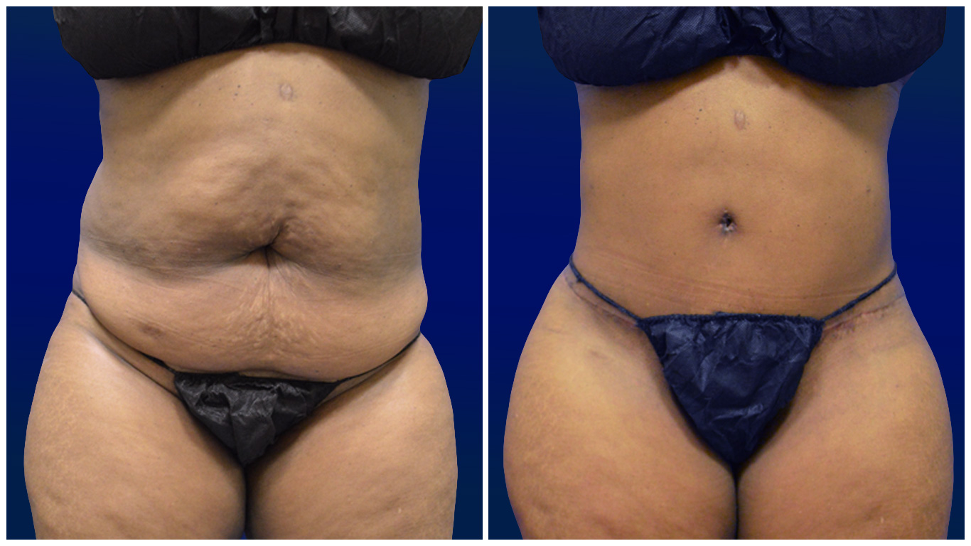Abdominal Liposuction Chicago - Chicago Liposuction by Lift Body Center